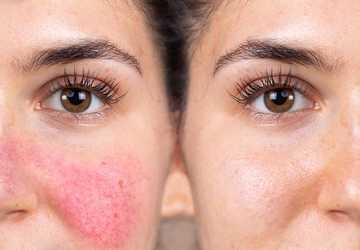 How to Treat Rosacea: Effective Skincare Tips